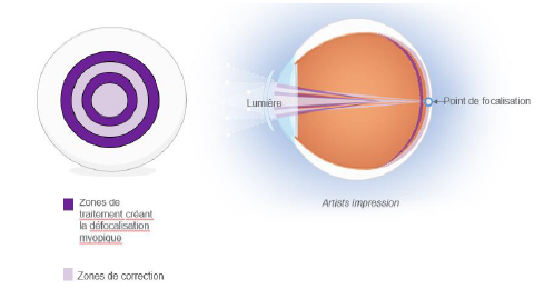 MiSight 1 day, la première lentille souple pour contrôler l’évolution de la myopie