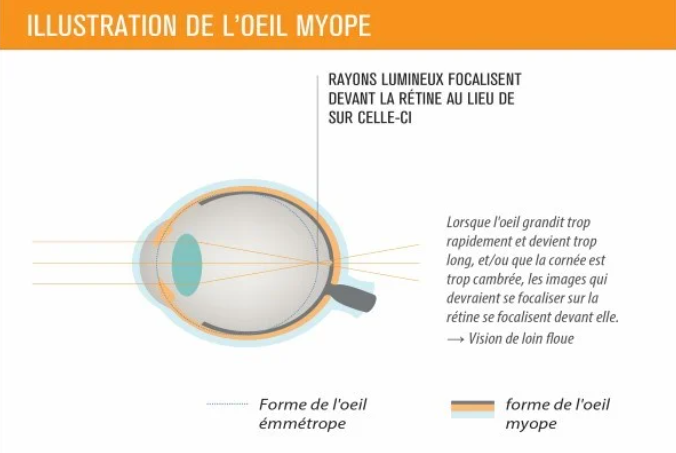 Illustration de l'oeil myope 