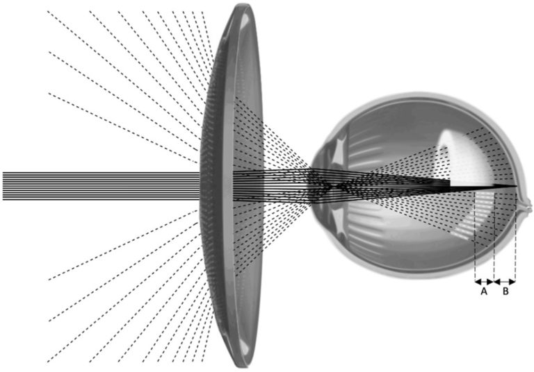 Illustration du dispositif d'étude fournissant un volume de défocalisation myope (VoMD) (coquille blanche) devant la rétine à tr