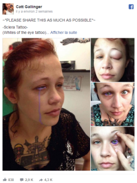 Tatouage de l’œil : une jeune canadienne risque de perdre la vue