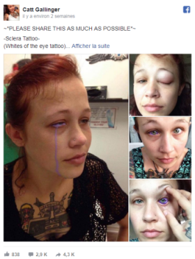 Tatouage de l’œil : une jeune canadienne risque de perdre la vue Tatouage de l’œil : une jeune canadienne risque de perdre la vue