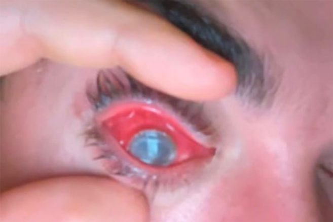 Un nouveau cas de kératite à Acanthamoeba crée des dégâts chez un jeune porteur de lentilles