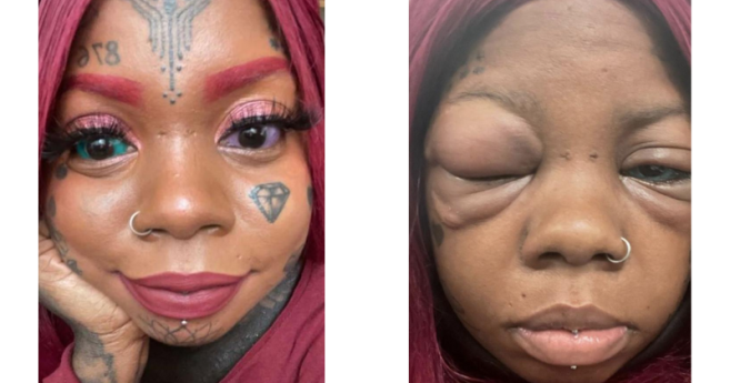 Elle se fait tatouer les globes oculaires et risque de devenir aveugle