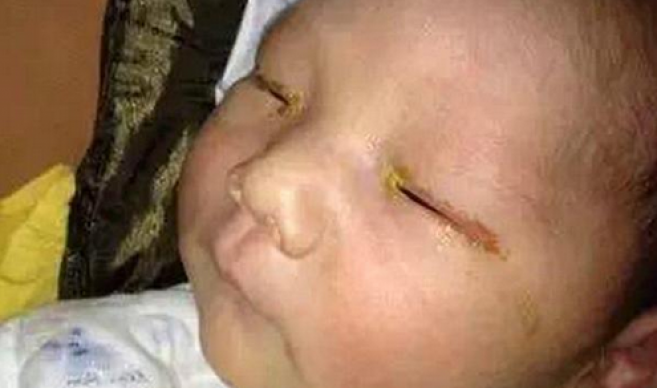 Un bébé de 3 mois devient quasiment aveugle à cause d’un flash trop rapproché 