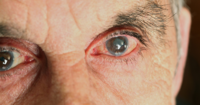 Glaucome : un microstent un peu plus épais qu'un cheveu ouvre de nouvelles perspectives chirurgicales