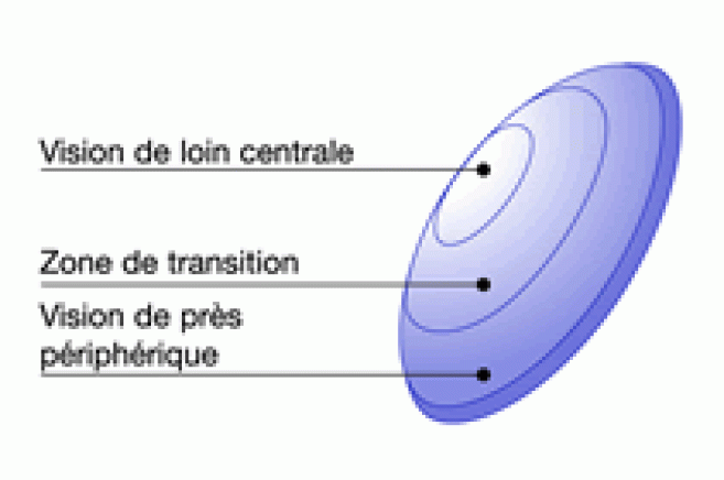 Une étude sur la Menifocal Z prouve la sécurité de cette lentille en port continu