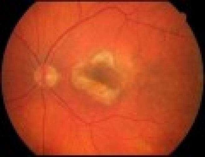 DMLA : le succès de greffes de cellules souches dans l'oeil offre un nouvel espoir
