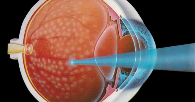  Les précisions sur l’erreur médicale de l’ophtalmologiste marseillais qui a rendu son patient aveugle