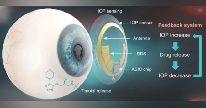 Corée : des chercheurs créent une lentille pour traiter le glaucome