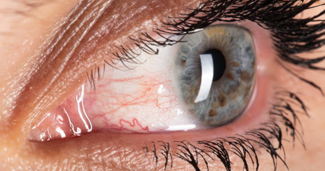 Sécheresse oculaire : Alcon et le conseil mondial d'optométrie lancent une plateforme d'aide au diagnostic