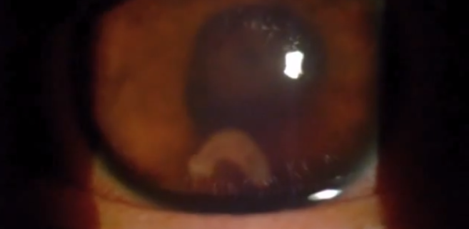 Un ver parasite retrouvé dans l’œil d’un patient de 17 ans