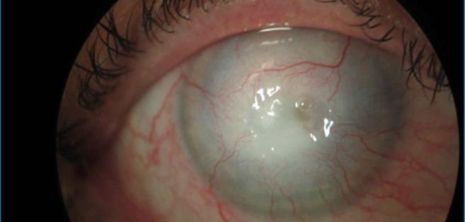 Une étudiante perd la vue après avoir porté ses lentilles de contact en continu