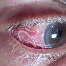 Un médecin retire le parasite de 15 cm logé dans l’oeil d’un patient