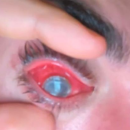 Un nouveau cas de kératite à Acanthamoeba crée des dégâts chez un jeune porteur de lentilles