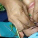Une larve de mouche extraite de l’œil d’un adolescent grâce à du basilic 