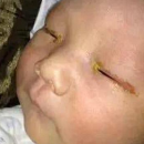 Un bébé de 3 mois devient quasiment aveugle à cause d’un flash trop rapproché 