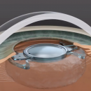 Traitement de la cataracte: un implant évolutif bientôt sur le marché français