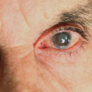 Glaucome: un microstent un peu plus épais qu'un cheveu ouvre de nouvelles perspectives chirurgicales