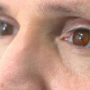 Un britannique bénéficie de la toute première prothèse oculaire imprimée en 3D
