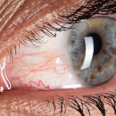 Sécheresse oculaire: Alcon et le conseil mondial d'optométrie lancent une plateforme d'aide au diagnostic