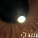 Innovation: des lentilles de contact pour dépister et suivre l’évolution du glaucome, une avancée majeure