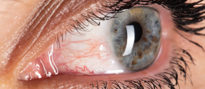 Sécheresse oculaire : Alcon et le conseil mondial d'optométrie lancent une plateforme d'aide au diagnostic