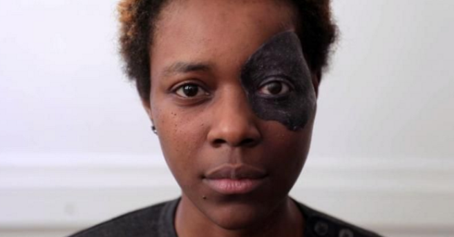 Prisca, 29 ans, a été victime d’un cancer de l’œil gauche