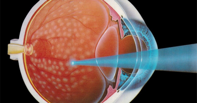 laser_yag_oculus_centre.png