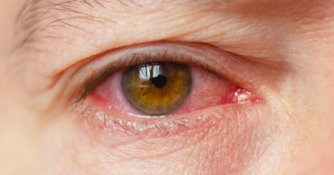 secheresse_oculaire_header.png