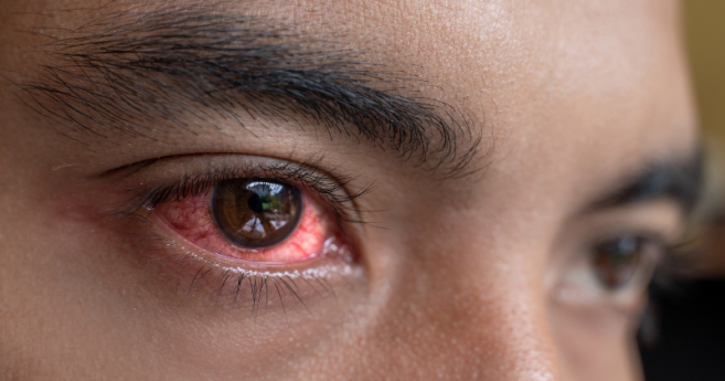 vitamine_a_dulcis_penurie_pommade_oeil_ophtalmique.png