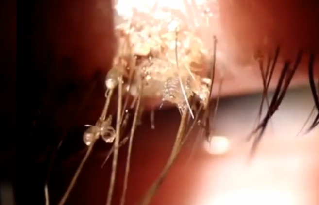 morpions_oeil.png