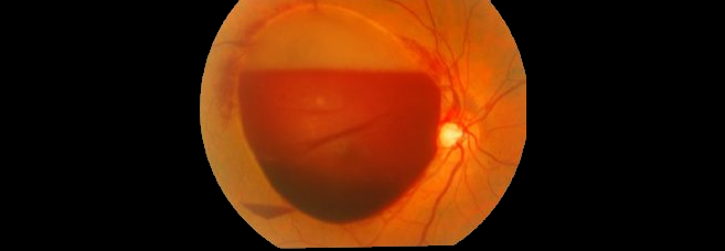 retinopathie_de_valsalva_post-coitale.png