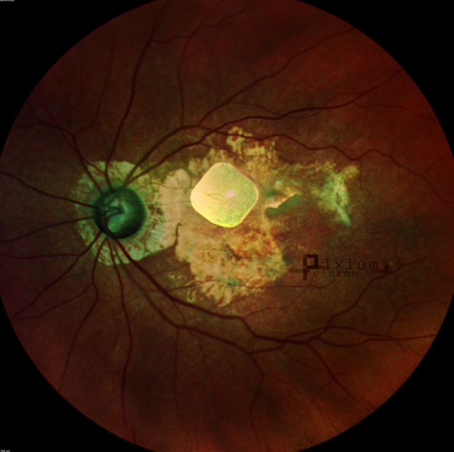 Image de l'implant rétinien Prima - ©Pixium Vision