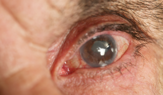 Zeiss Envision Glaucoma depistage