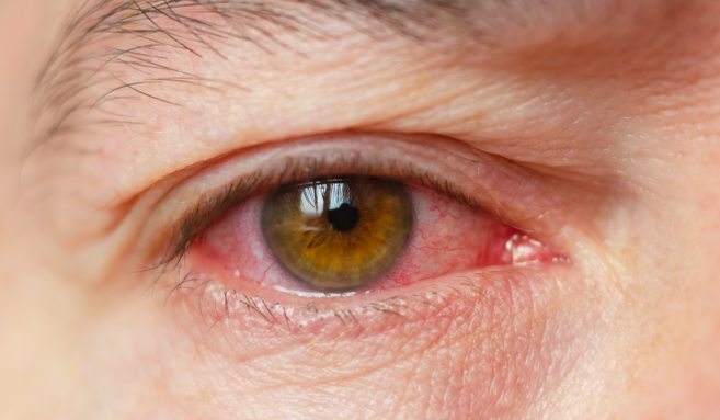 Oeil sec