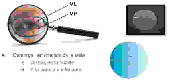 Myopilux Max - Essilor