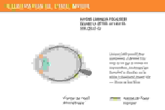 Illustration de l'oeil myope&nbsp;