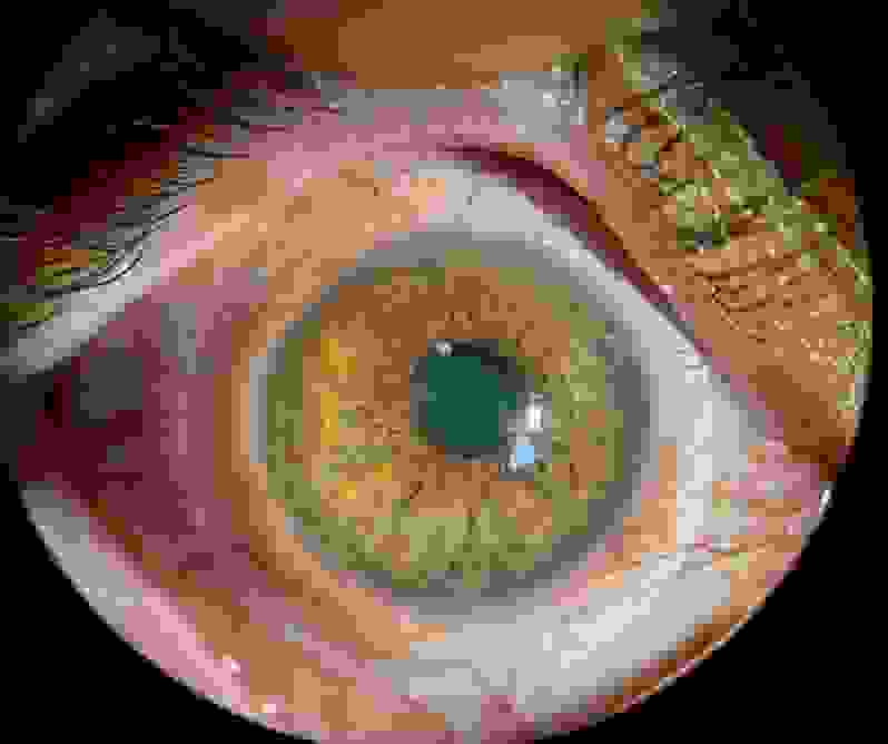 hyperhemie_perilimbique_sur_sclerale.png