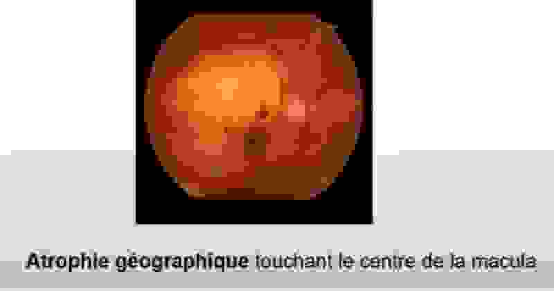 atrophie_geographique.png