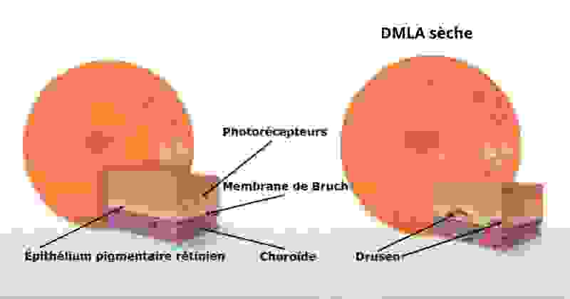 dmla_seche.png